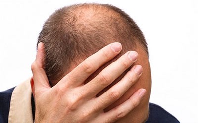 الگوی طاسی یا ریزش مو در مردان